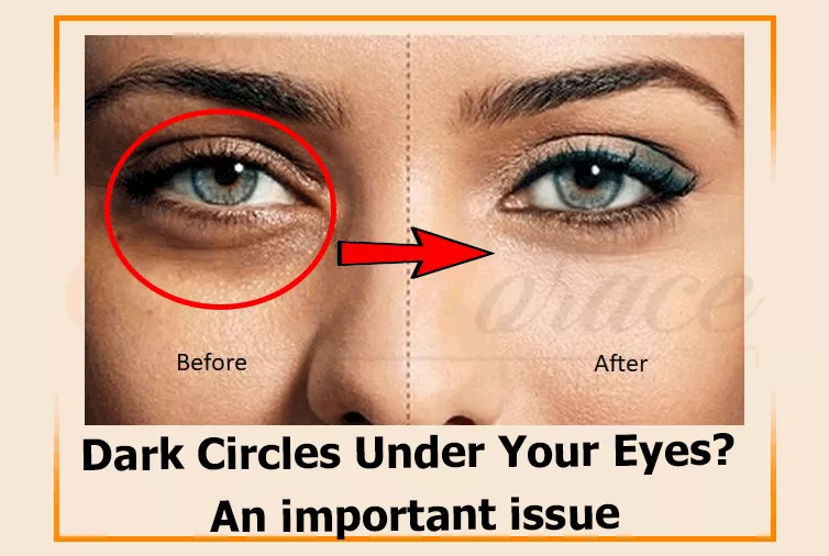 Dark Circles Under Your Eyes? An important issue